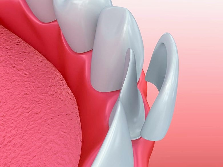 Do I Need Veneers?