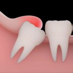 why do we have wisdom teeth