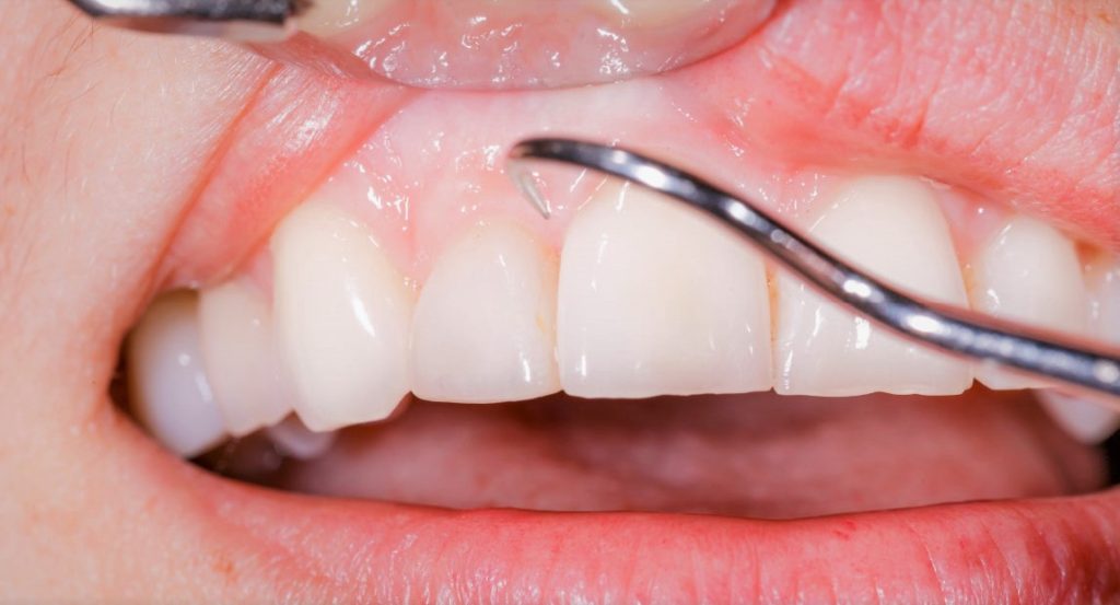 What is Gingivitis?